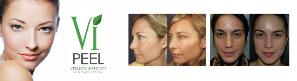 VI Peel before and after compilation